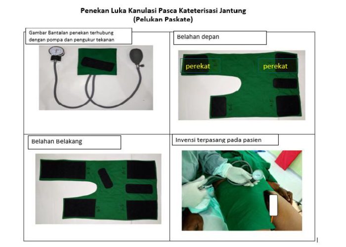 penekan luka kanulasi pasca kateterisasi jantung (pelukan paskate)