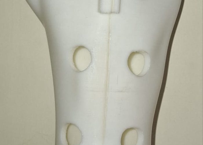 SHORT ARM CAST 3D PRINTING UNTUK FRAKTUR RADIUS DISTAL YANG NYAMAN DAN AKURAT